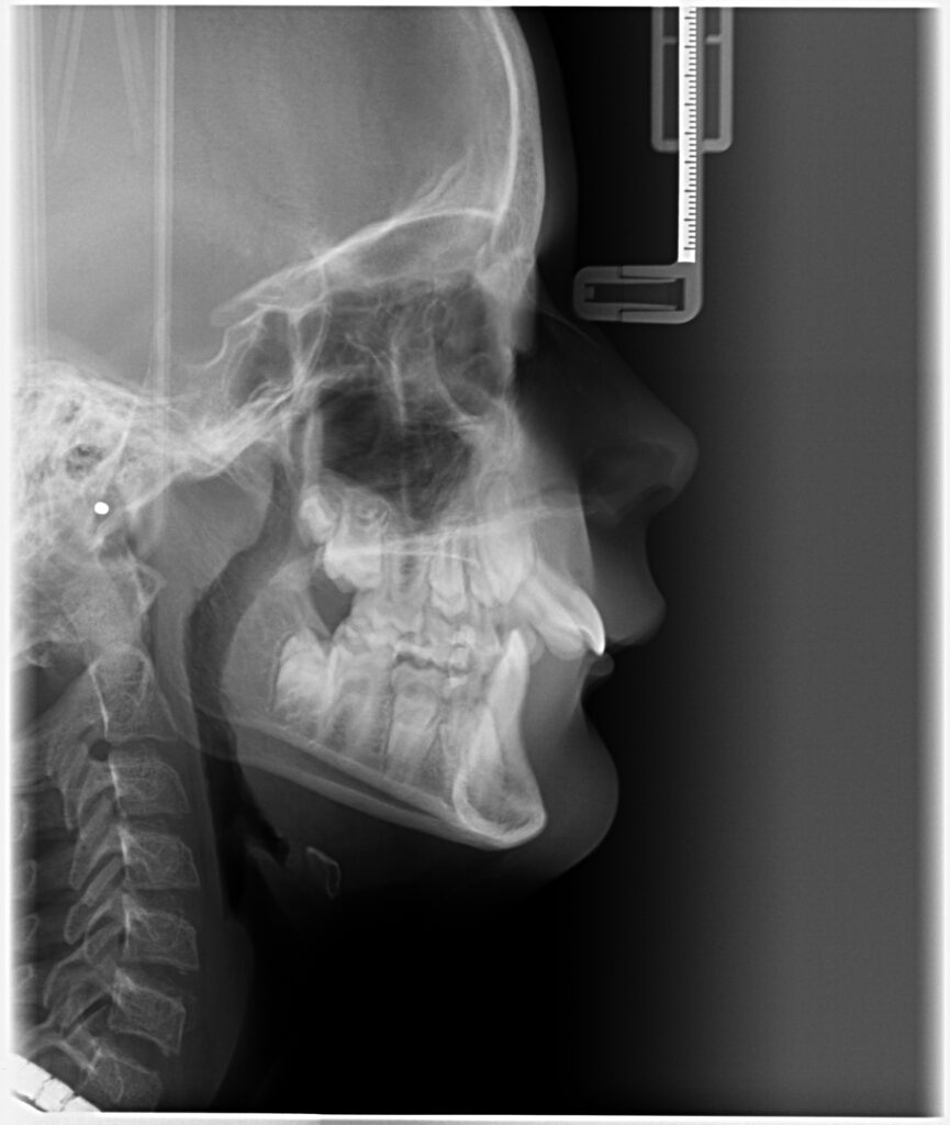 ausgeprägte sagittale Schneidekantenstufe im Fernröntgenseitenbild